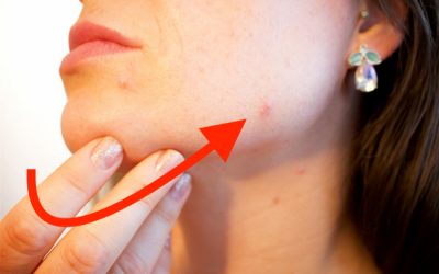The Best Probiotics for Acne: Complete 2026 Buying Guide